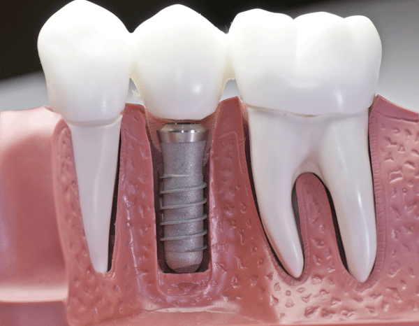Имплантация зубов (рис. 21)